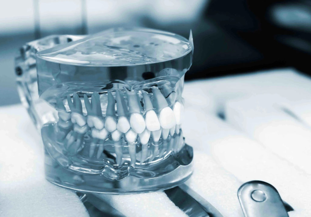Moulage dentaire monte sur articulateur pour l analyse de l occlusion